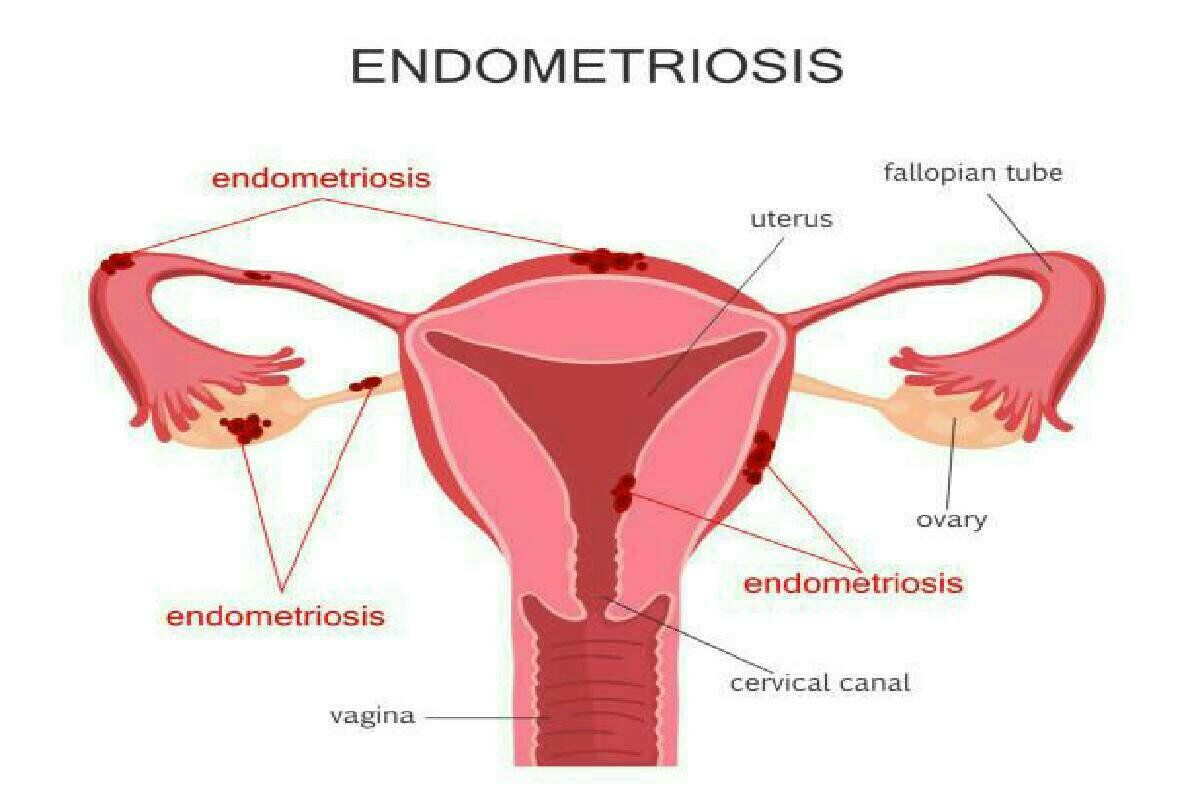 A structure of endometriosis