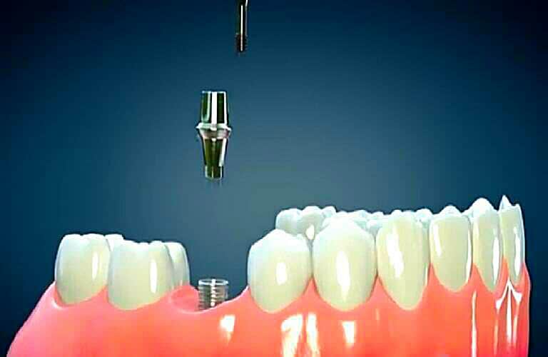 What Is The Average Cost Of Dental Implants
