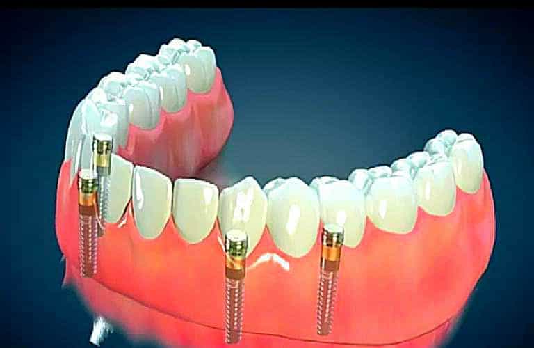 What Is The Average Cost Of Dental Implants? (2023)
