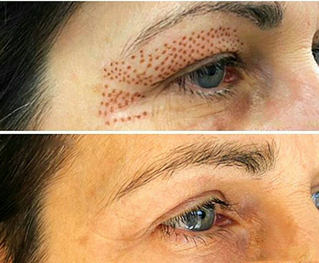 Plasma Fibroblast Before And After Treatment