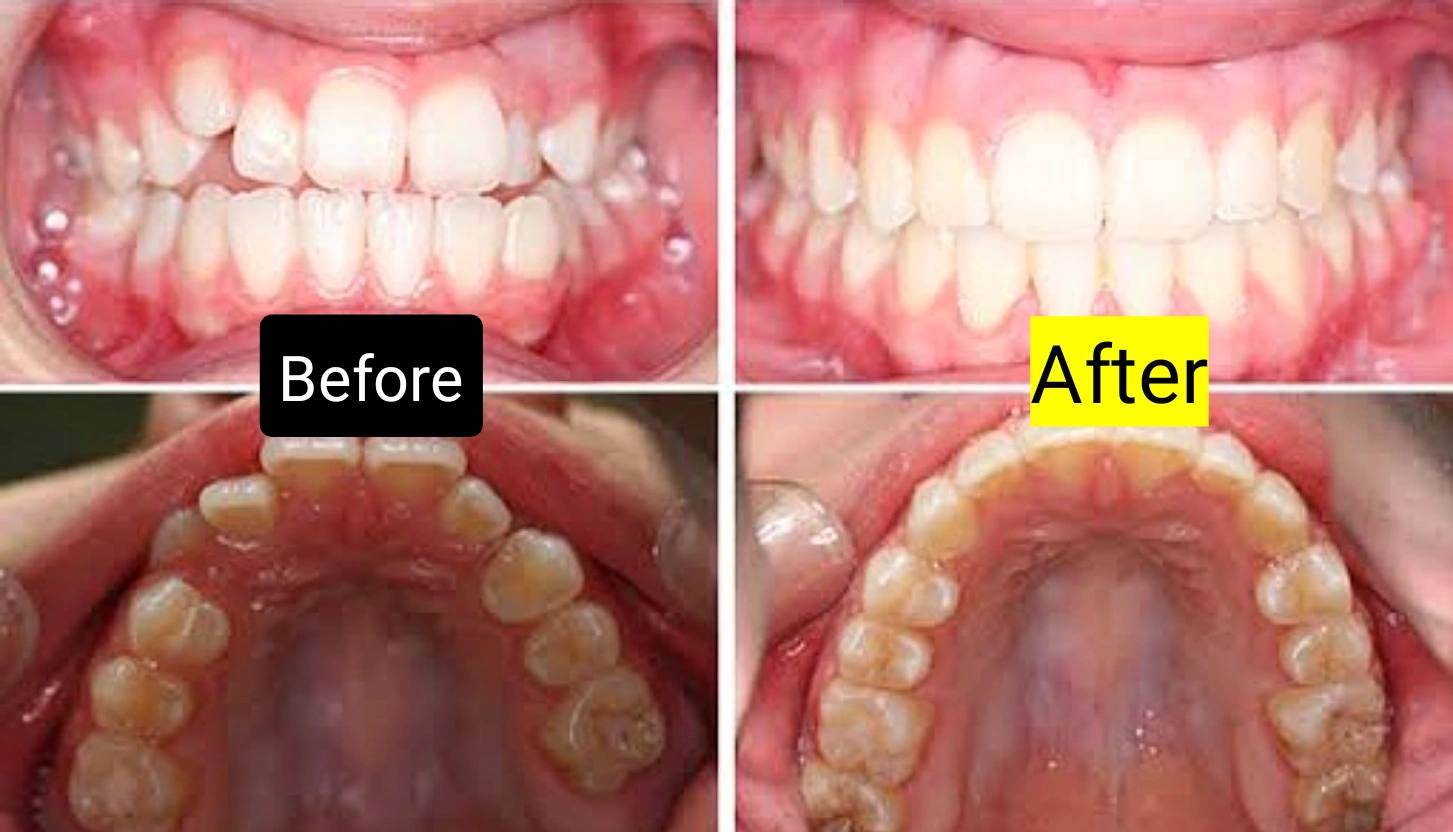 Before And After Palate Expander Adults