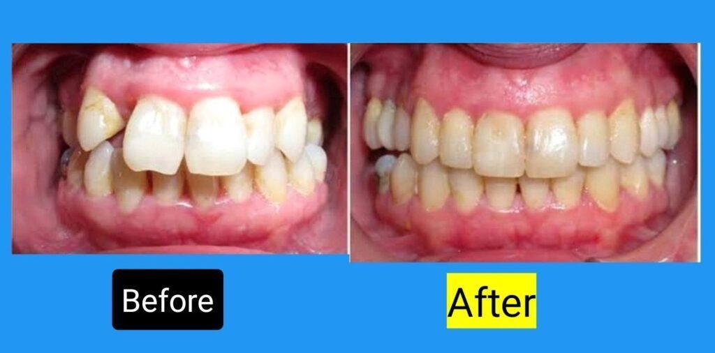 Invisalign Overbite Before And After worse cases
