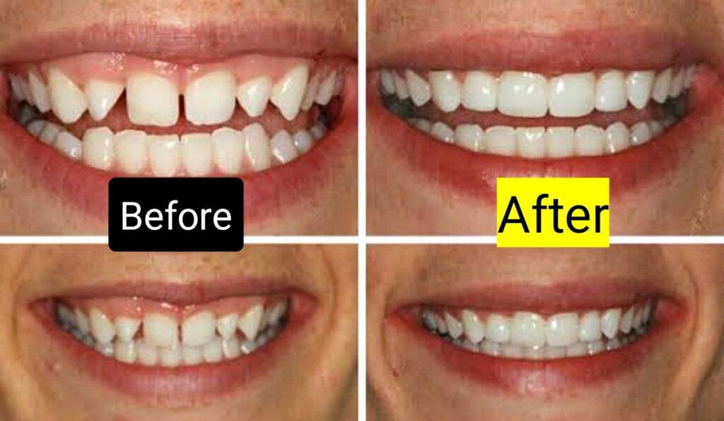Invisalign Overbite Before And After