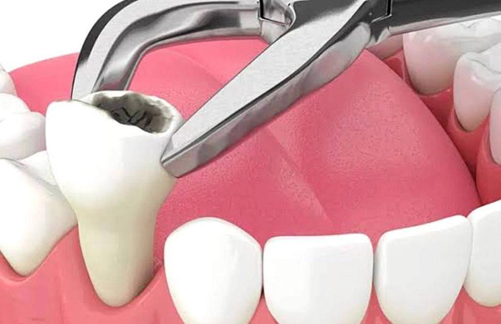 Which Teeth Are Most Likely To Have Dry Socket?