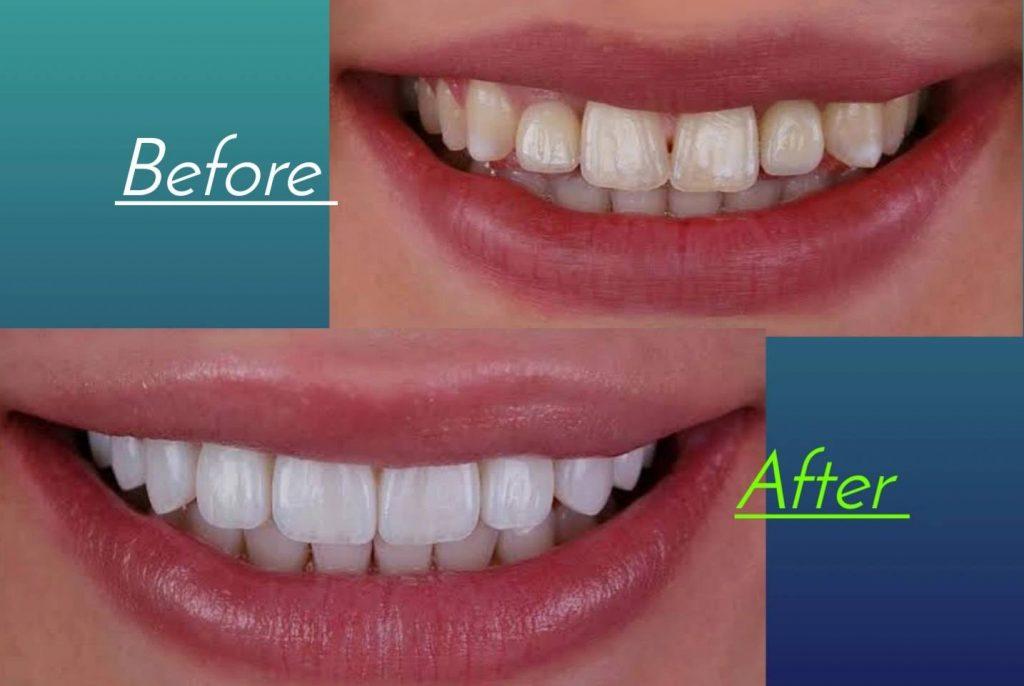 Front Teeth Crowns Before And After