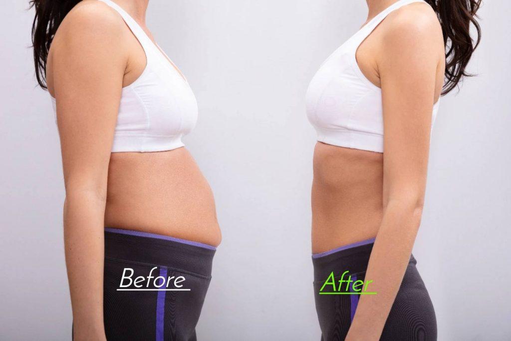 Pregnancy Tummy Tuck Before And After