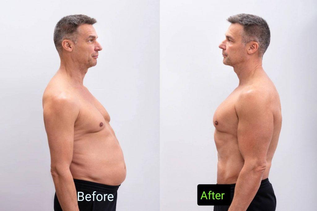 Tummy Tuck Before And After Male