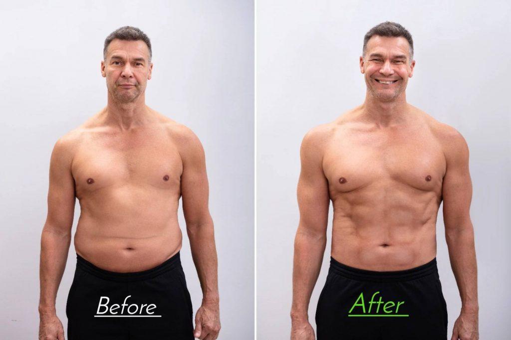 Tummy Tuck Before And After Male: Quality Photos
