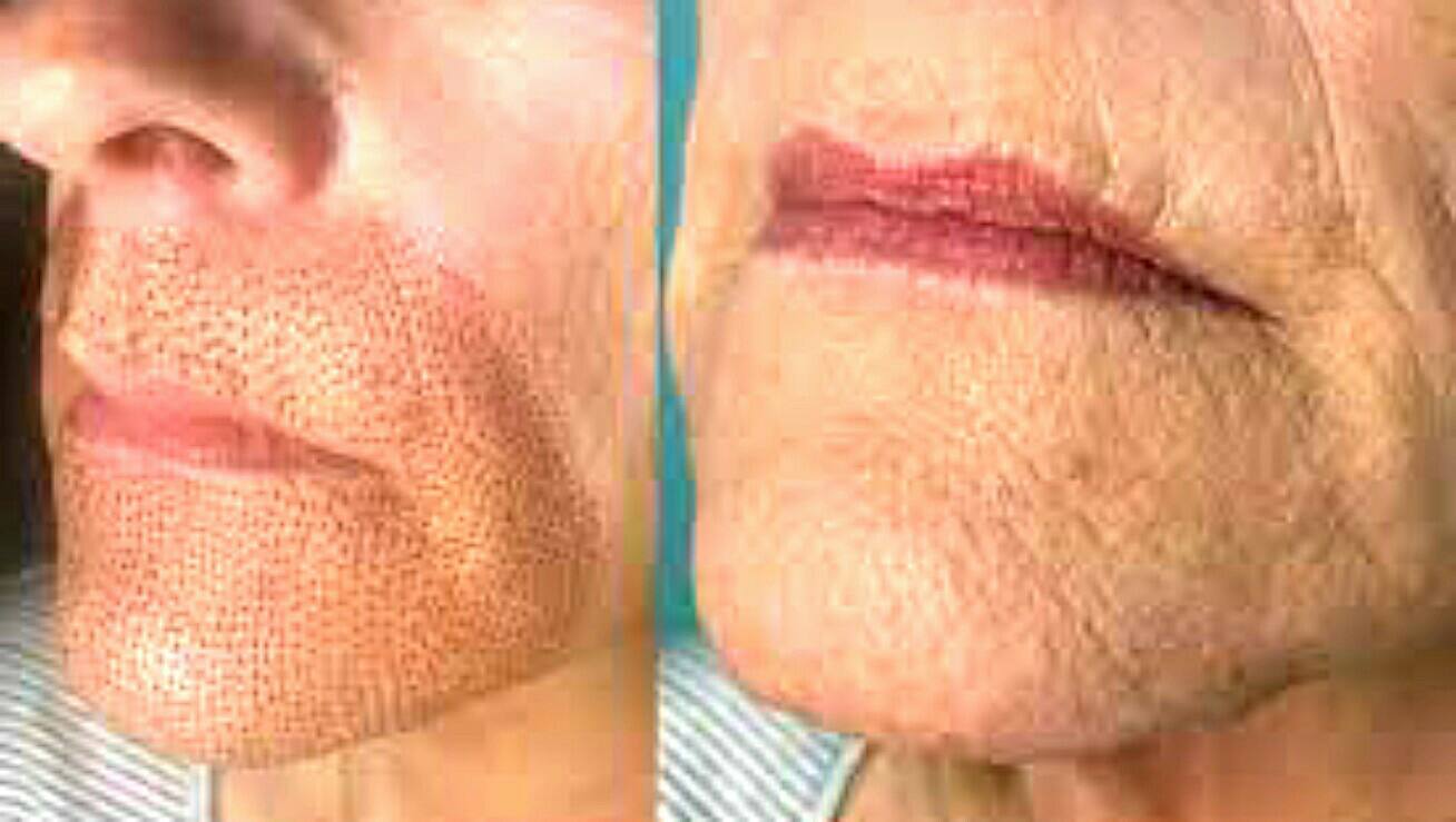 Plasma Fibroblast Before And After Treatment