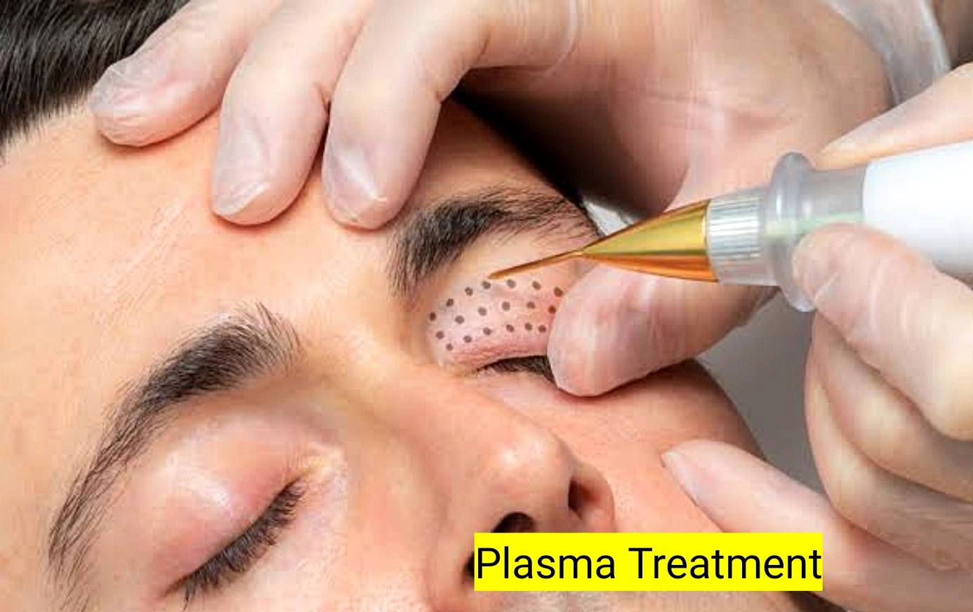 Plasma fibroblast reviews
