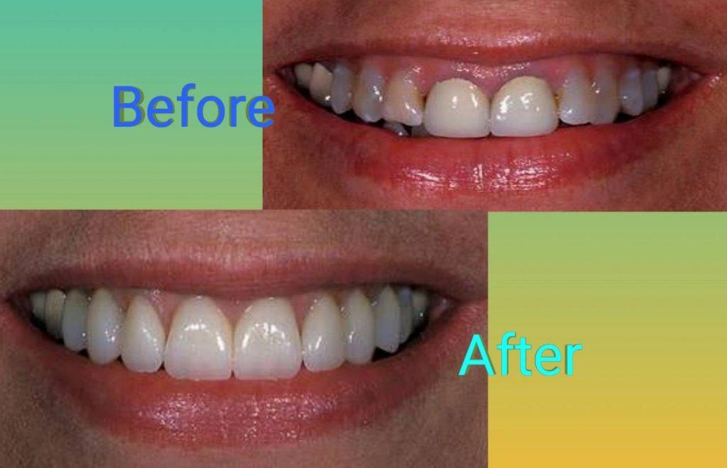 Front Teeth Crowns Before And After
